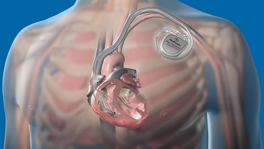 Implanted Cardiac Device Monitoring